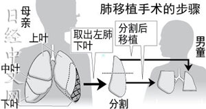 日本成功實施全球較精細(xì)活體肺移植手術(shù)（圖）