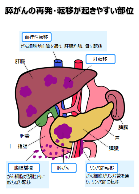 日本胰腺癌治療
