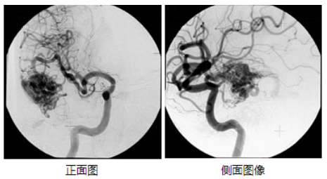 腦動靜脈畸形治療