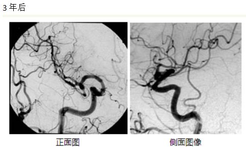 腦動靜脈畸形治療