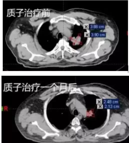 質子治療