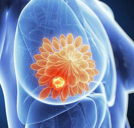 美國乳腺癌治療