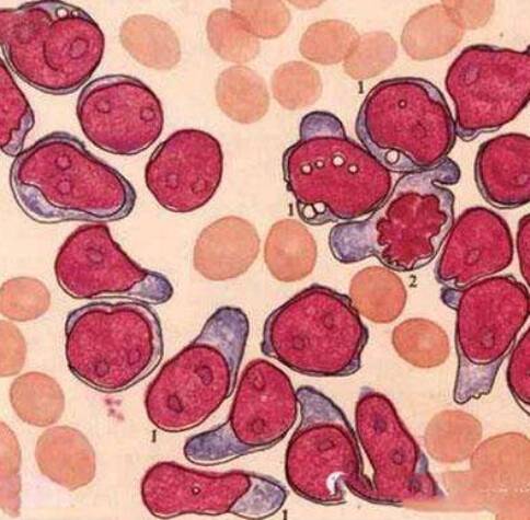 美國(guó)看病白血病