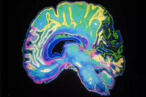 阿爾法-突觸核蛋白在修復(fù)斷裂DNA方面發(fā)揮關(guān)鍵作用