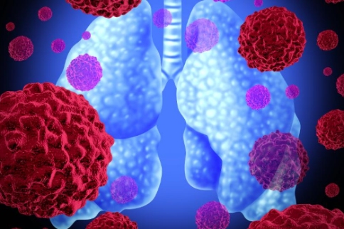 國(guó)外肺癌治療