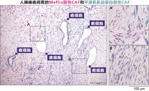 胰腺癌出國治療：這種細胞竟然可以抑制胰腺癌生長？