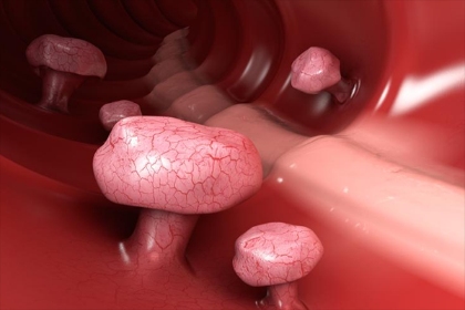 LifeKit Prevention在結(jié)腸癌檢測方面具有很高的準(zhǔn)確性