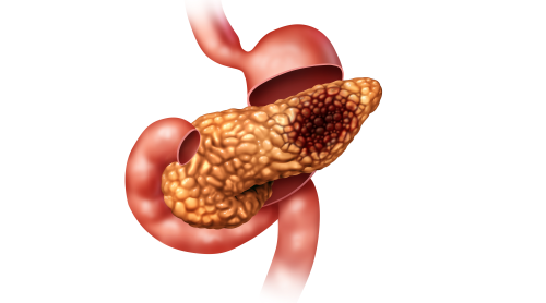 胰腺癌出國治療：研究發(fā)現(xiàn)胰腺癌轉(zhuǎn)移原因，胰腺癌轉(zhuǎn)移新治療方法或?qū)⒊霈F(xiàn)