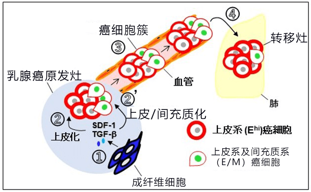 乳腺癌出國治療：日本研究人員發(fā)現(xiàn)乳腺癌浸潤轉移新機制！