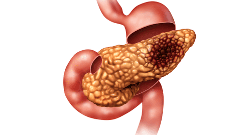 胰腺癌出國治療：真菌微生物與胰腺導(dǎo)管腺癌的發(fā)生具有密切聯(lián)系！