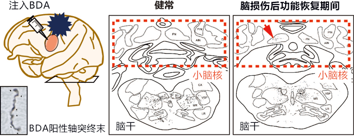 出國看病：研究發(fā)現(xiàn)大腦損傷后會形成新的神經(jīng)束，或可治療腦部疾病