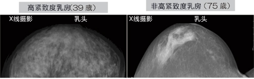 乳腺癌如何檢查？日本開發(fā)出一種新技能可用于早期檢測乳腺癌