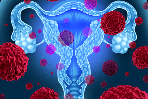 子宮肌瘤的治療