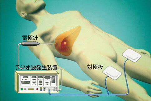 肝癌射頻消融術