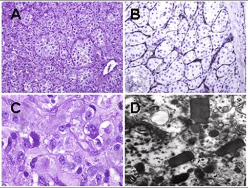 肺泡樣軟組織肉瘤