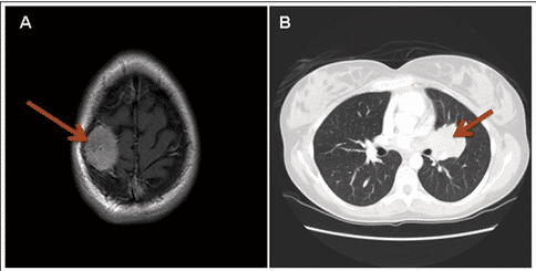 肺泡樣軟組織肉瘤診斷治療