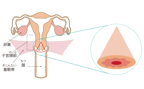 日本治療宮頸癌 日本治療宮頸癌