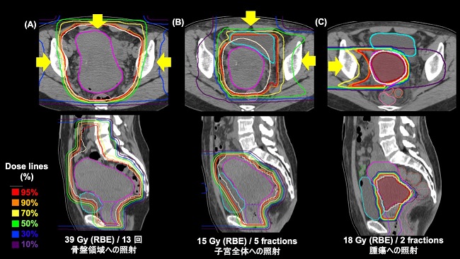 宮頸癌治療方法 宮頸癌治療方法