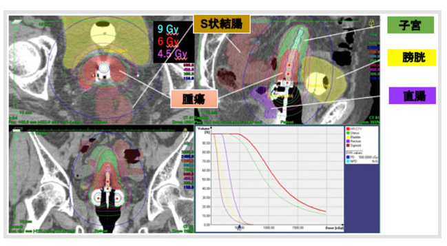子宮癌放射治療 子宮癌放射治療