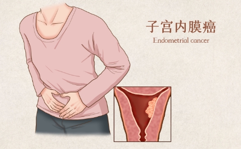 子宮癌前沿治療方法 子宮癌前沿治療方法