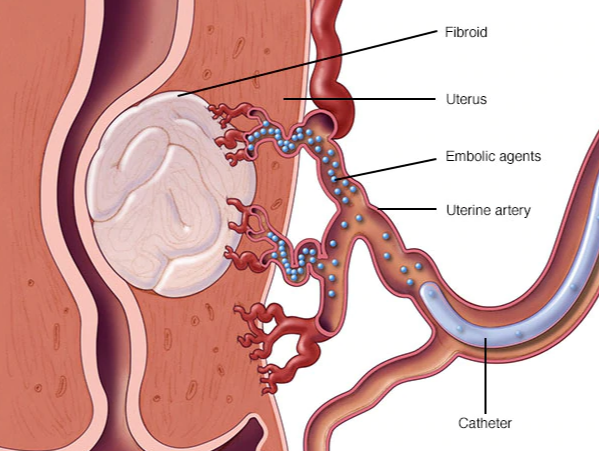 美國子宮肌瘤治療方法 美國子宮肌瘤治療方法