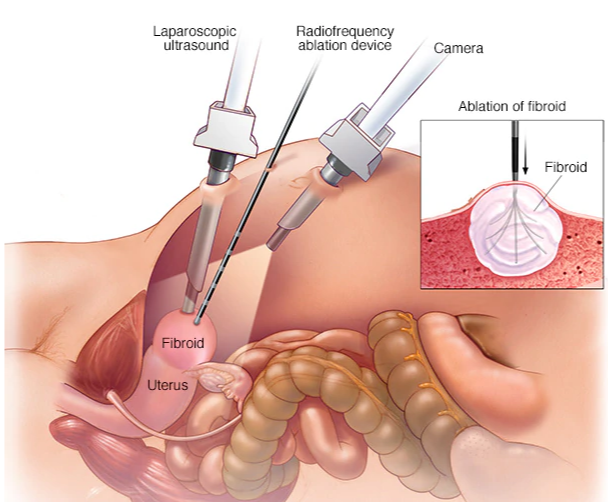 美國子宮肌瘤治療方法 美國子宮肌瘤治療方法
