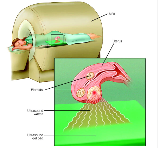美國子宮肌瘤治療方法 美國子宮肌瘤治療方法
