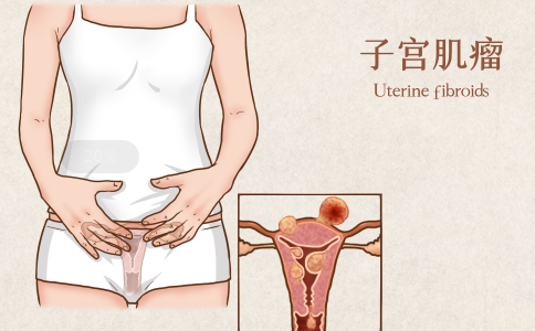 美國子宮肌瘤治療方法 美國子宮肌瘤治療方法