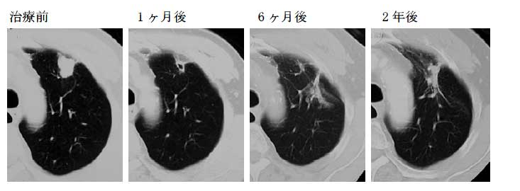 質(zhì)子治療癌癥