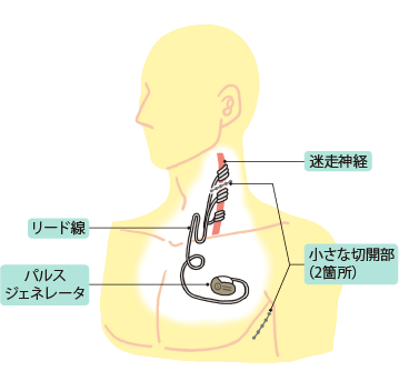 日本治療癲癇