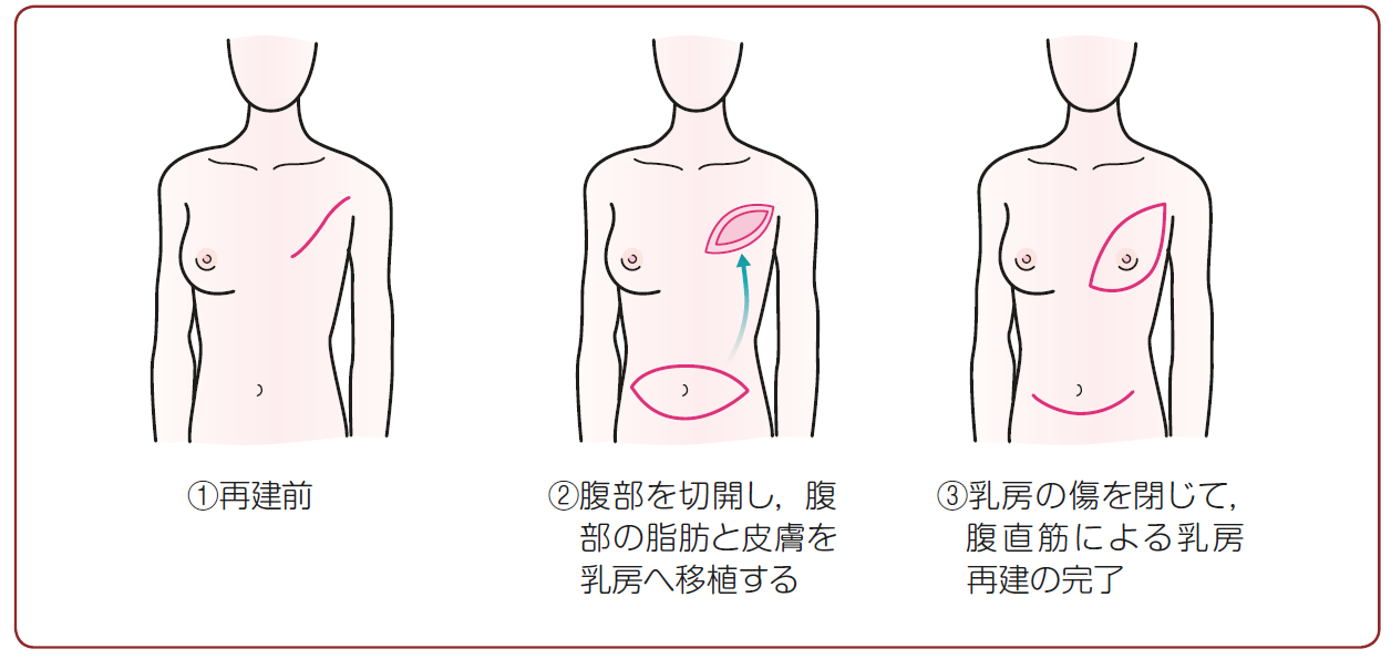乳房重建 乳房重建