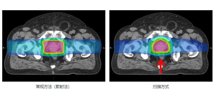 質子治療前列腺癌的劑量分布