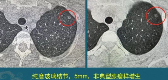 肺磨玻璃結節(jié)
