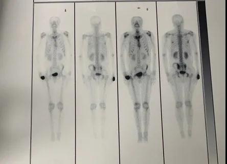 骨肉瘤復發(fā)