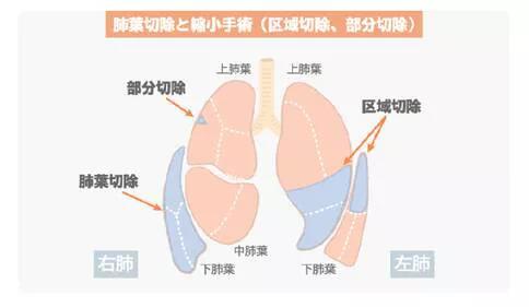 肺癌手術治療