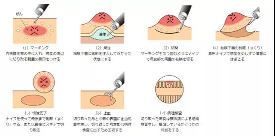 內鏡治療胃癌和腸癌