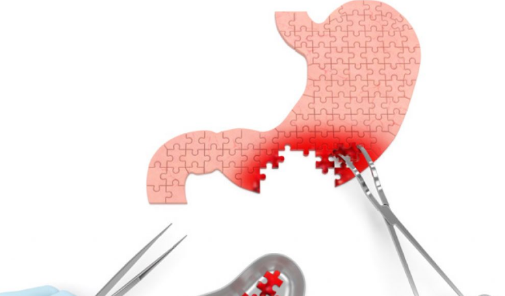 美國胃癌手術(shù) 美國胃癌手術(shù)