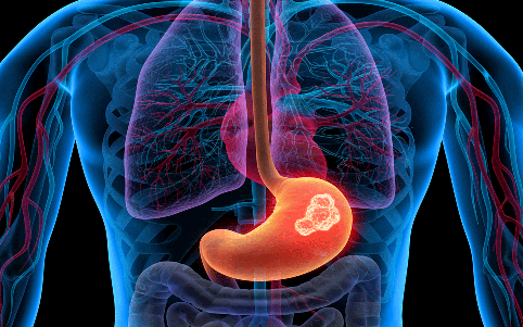 胃癌晚期日本看病