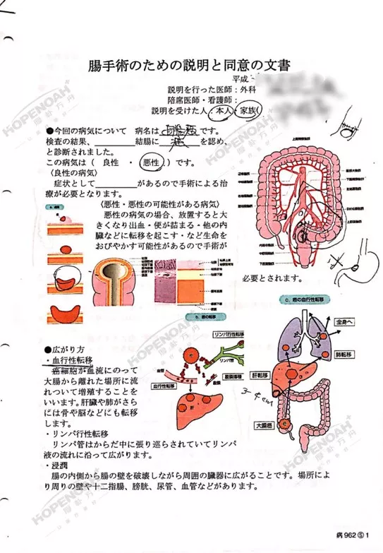 日本直腸癌保肛